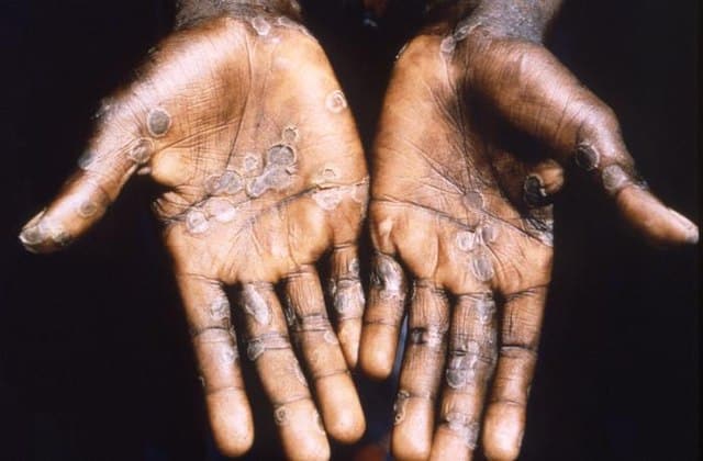 monkeypox on hands